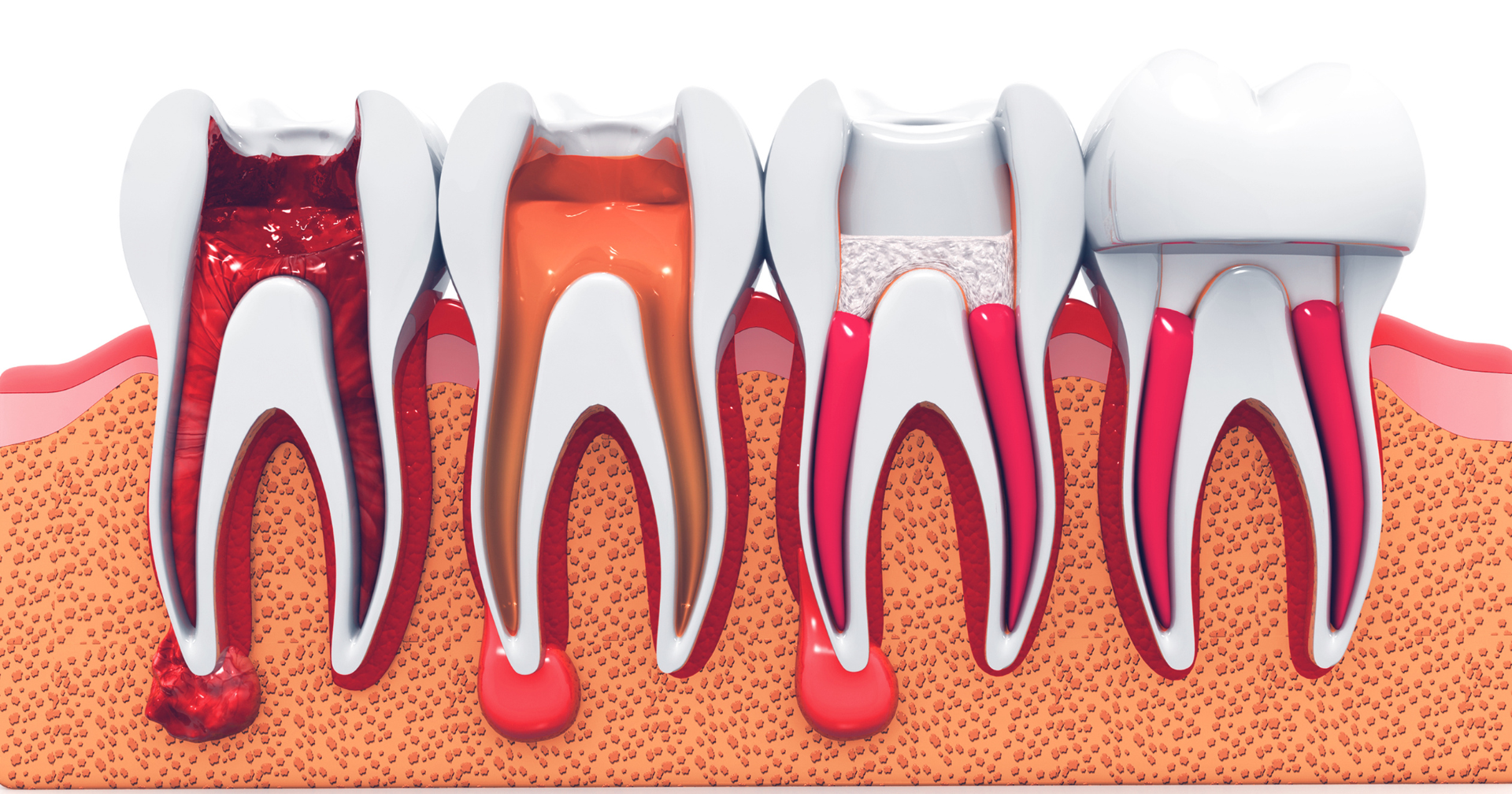 Root Canal Specialist Bakersfield CA Riar Dental Arts Root Canal Specialist Bakersfield CA Riar Dental Arts